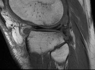 Mensicus Failed Repair MRI0002